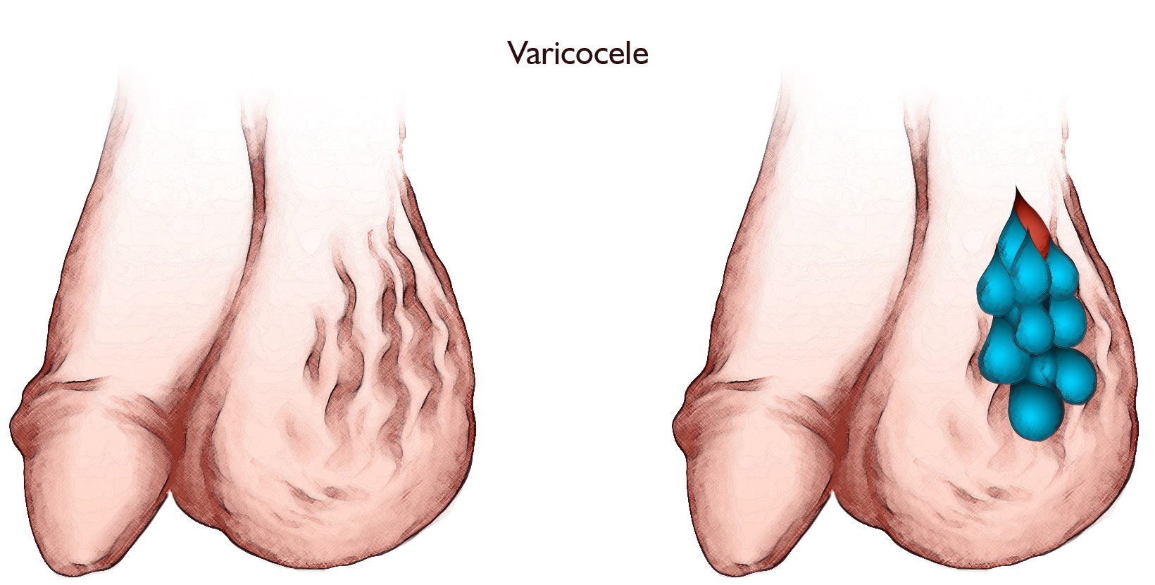 Varicocele